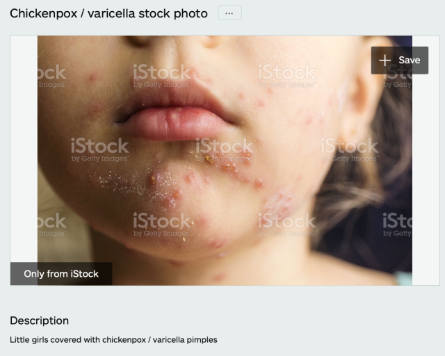 child with chicken pox pimples/varicella